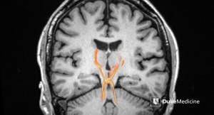 The X-shaped pathway of nerve fibers represents the dentatorubrothalamic tract (DRT), a pathway inside the thalamus that researchers target with deep brain stimulation to halt uncontrolled tremors. Photo courtesy Evan Calabrese, Duke Medicine.