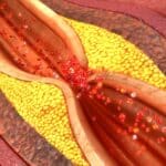 GE, Medis Partner for Non-Invasive CAD Diagnostics