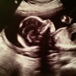 Fewer 20-Week Ultrasounds Linked to Insurance Disparities
