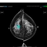 Danish Study Finds AI Reduces Radiologist Workload by 50%