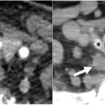CT Imaging Identifies Patients at Risk for Undiagnosed PHPT