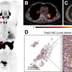 New Imaging Agent Identifies Key Cancer Biomarker Trop2