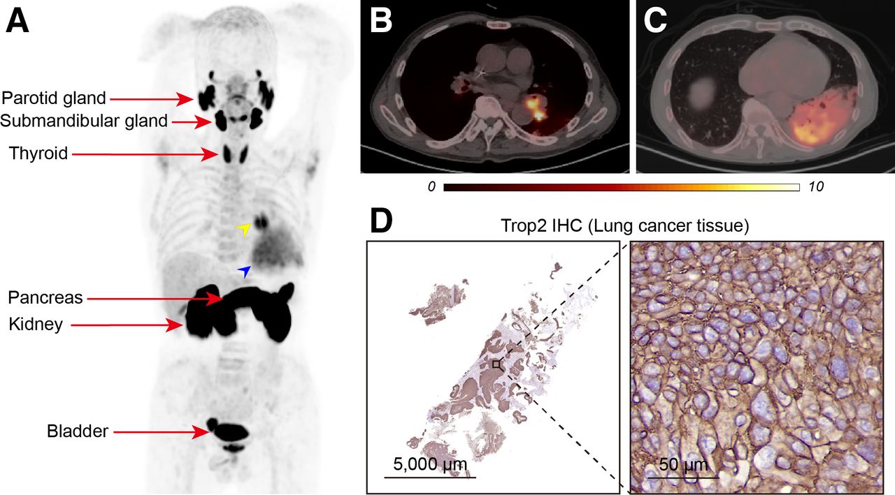 New Imaging Agent Identifies Key Cancer Biomarker Trop2