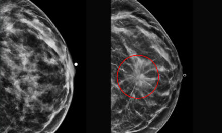 Machine Learning Enhances Early Detection of Breast Cancer Risk