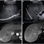 LI-RADS Ultrasound Version 2024 Increases HCC Sensitivity