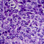 MRI Cuts Bladder Cancer Treatment Time by 45 Days