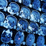 MRI-Based AI Offers Non-Invasive Cancer Insights