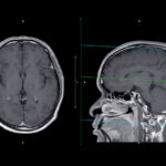 New Contrast Agent Achieves 60% Reduced Gadolinium Dose