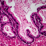 AI Can Improve Ovarian Cancer Diagnoses