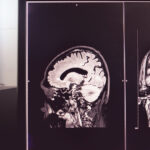 MRI Ties Cognitive Decline to Temporal Vessel Issues