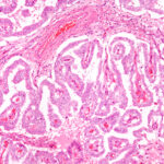SNMMI Launches Thyroid Cancer Registry Pilot