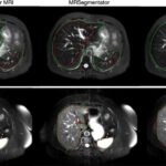 AI Model Outperforms Public Tools in MRI Segmentation