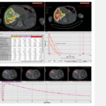 FDA Clears New Version of PLANET Onco Dose Dosimetry Software