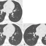 AI-Enhanced Ultra-Low Dose CT Detects Pneumonia