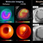 PET Imaging of Inflammation May Help Predict Heart Attack Recovery