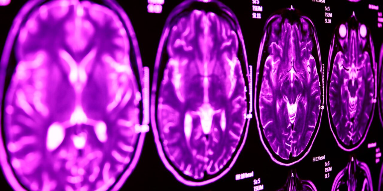 AI Brain Scan Model Identifies Stroke, Brain Tumors, and Aneurysms
