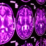 AI Brain Scan Model Identifies Stroke, Brain Tumors, and Aneurysms