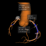 New Siemens Software Brings Automated Plaque Analysis to Cardiac CT