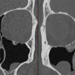 25 Years of CT Advances Have Cut Radiation Dose by Up to 10-Fold, Review Finds