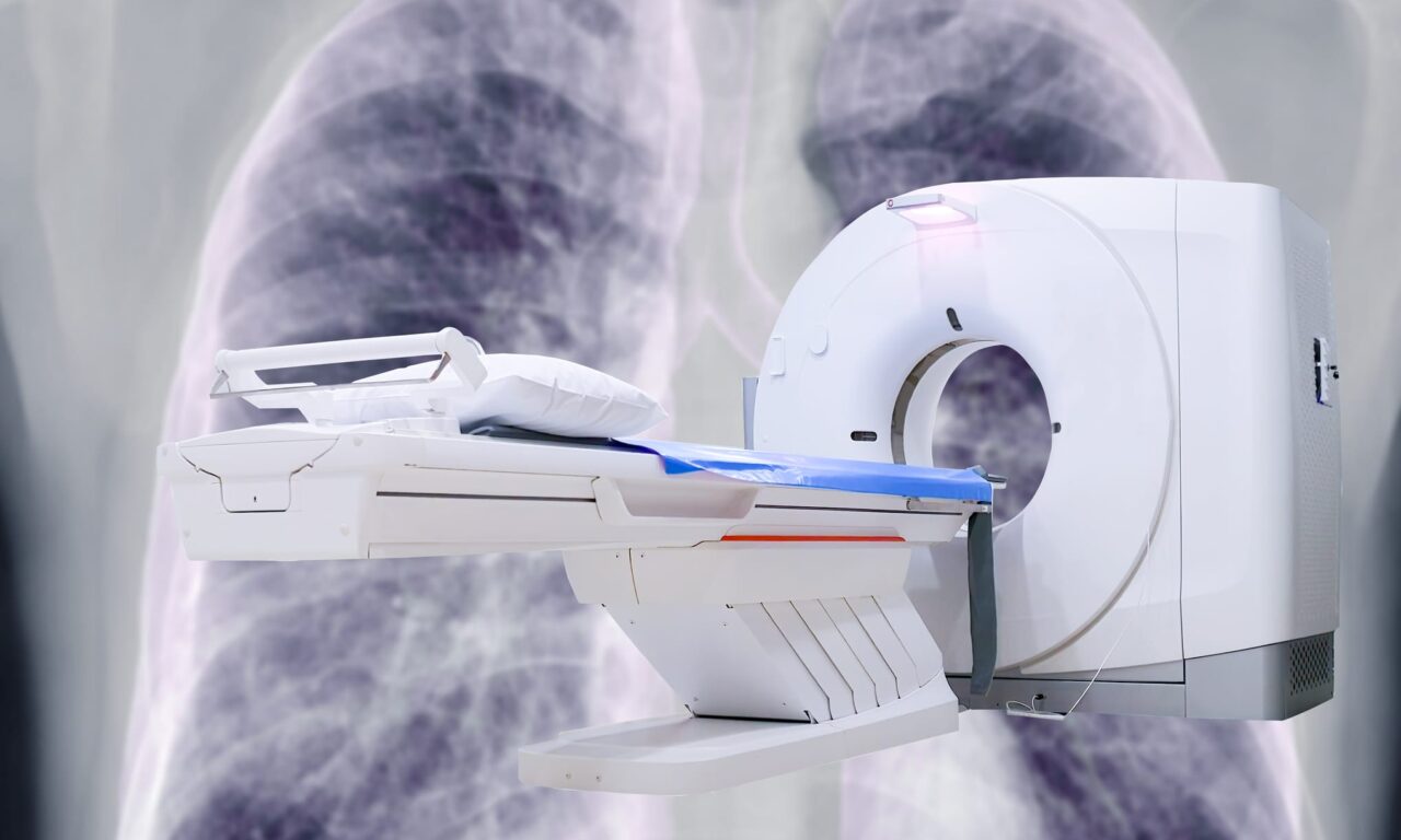 Photon-counting CT Outperforms Conventional CT in Lung Cancer Management