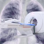 Photon-counting CT Outperforms Conventional CT in Lung Cancer Management