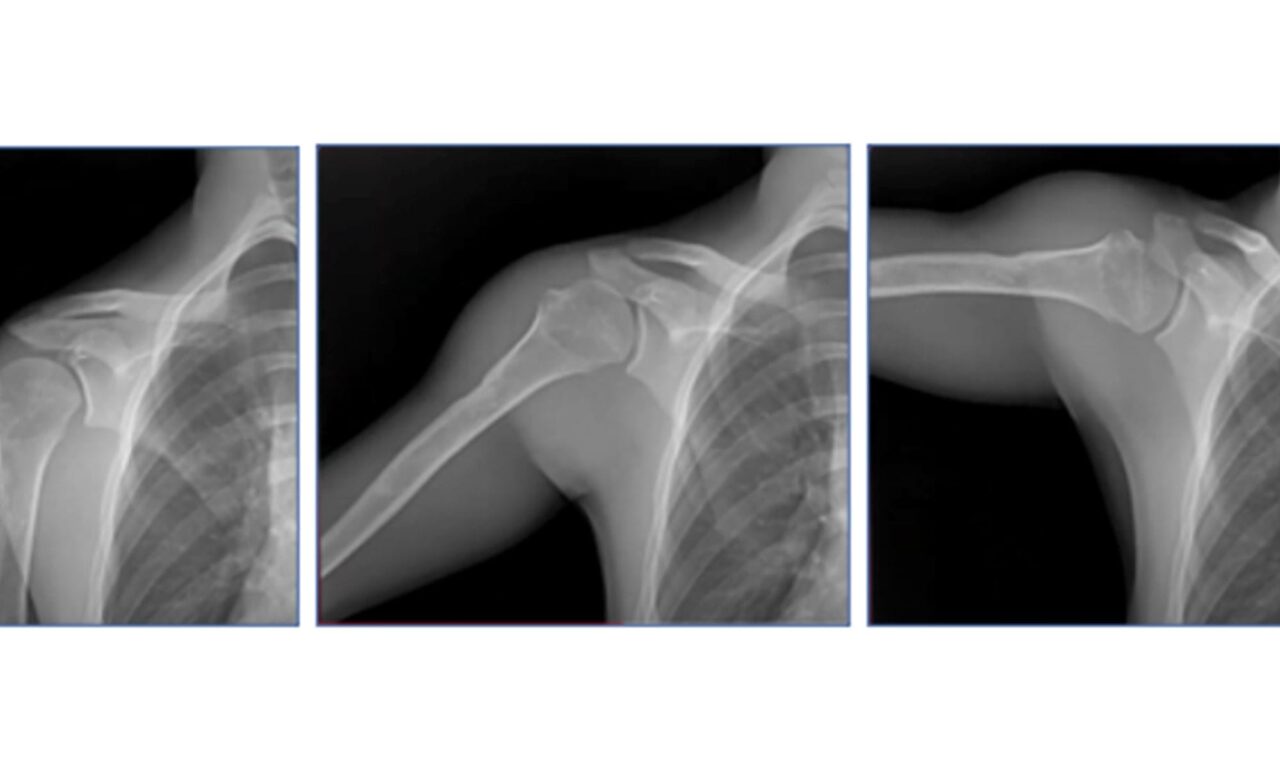 Dynamic Digital Radiography Quantifies Shoulder Biomechanics After Arthroplasty