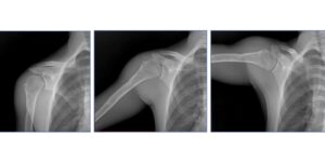 Dynamic Digital Radiography Quantifies Shoulder Biomechanics After Arthroplasty