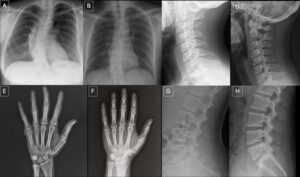 Deepfake X-rays Fool Radiologists and AI