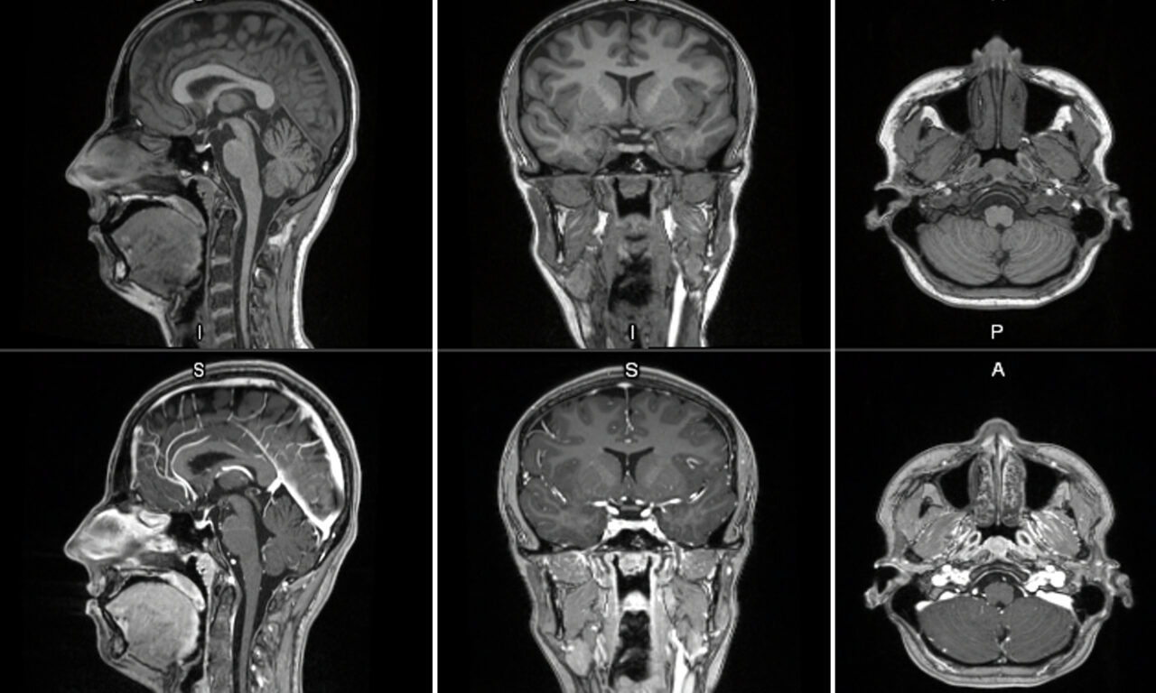 GE HealthCare Begins Phase 2/3 Trial for Manganese-Based MRI Contrast Agent
