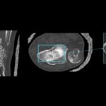 FDA Clears Deep Learning CT Reconstruction Tool for High-resolution Imaging